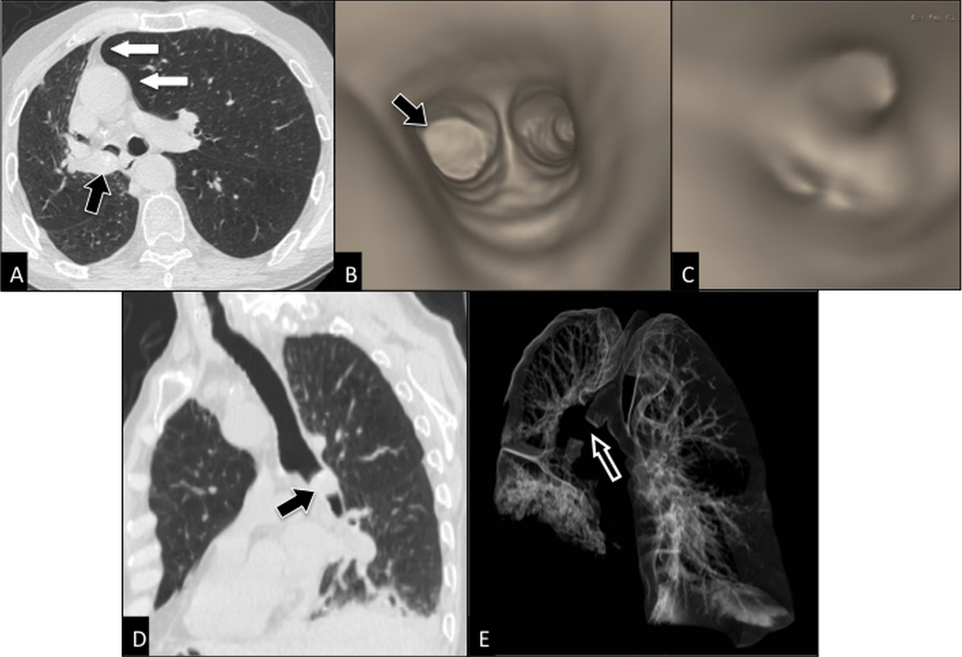 Aging Airways: between Normal and Disease. A Multidimensional
