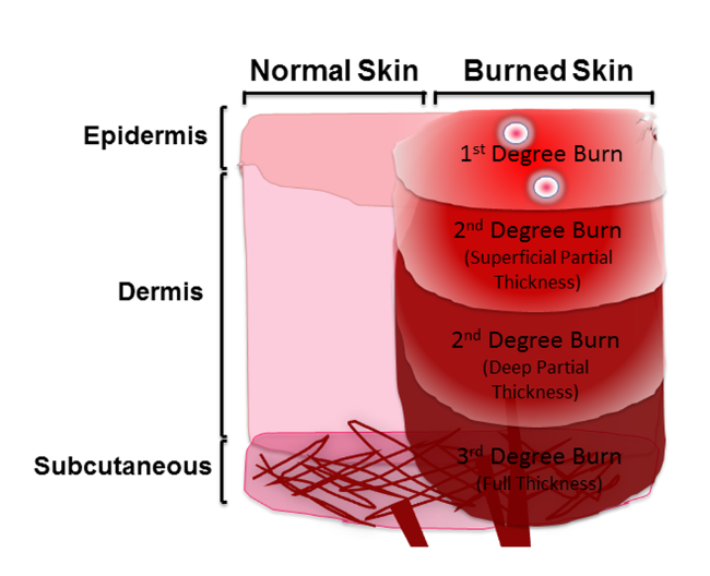 2nd Degree Burn Diagram
