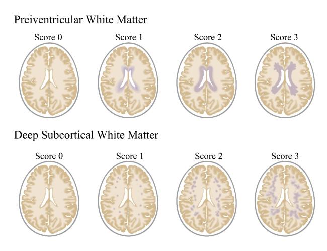 Periventricular on sale white matter